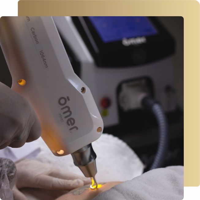 curso despigmentação a laser